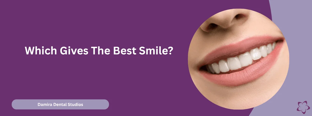 Which Gives The Best Smile Composite Bonding Vs Veneers